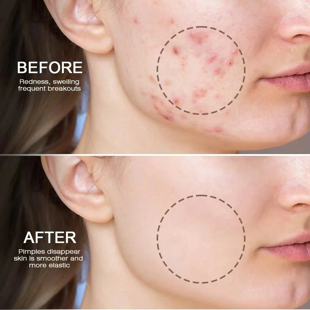 Bee Acne Gel – Natural Pimple Treatment